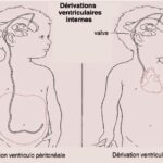 ventriculo-peritoneale_ventriculo-atriale.jpg