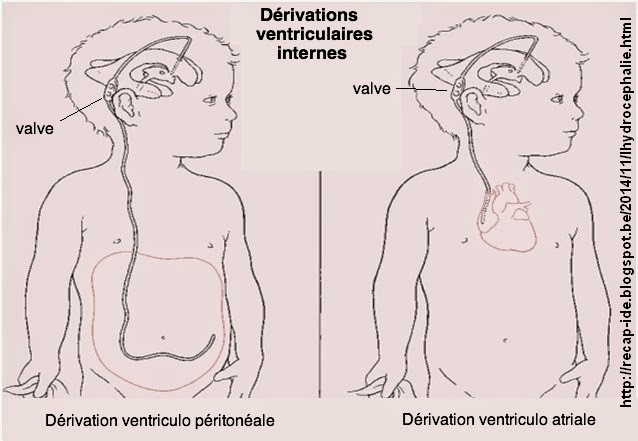 ventriculo-peritoneale_ventriculo-atriale.jpg